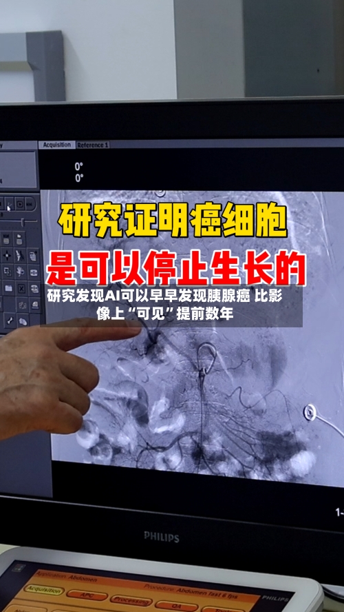 研究发现AI可以早早发现胰腺癌 比影像上“可见”提前数年-第2张图片